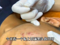 去黑头视频,告别毛孔烦恼——跟随视频教程学技巧